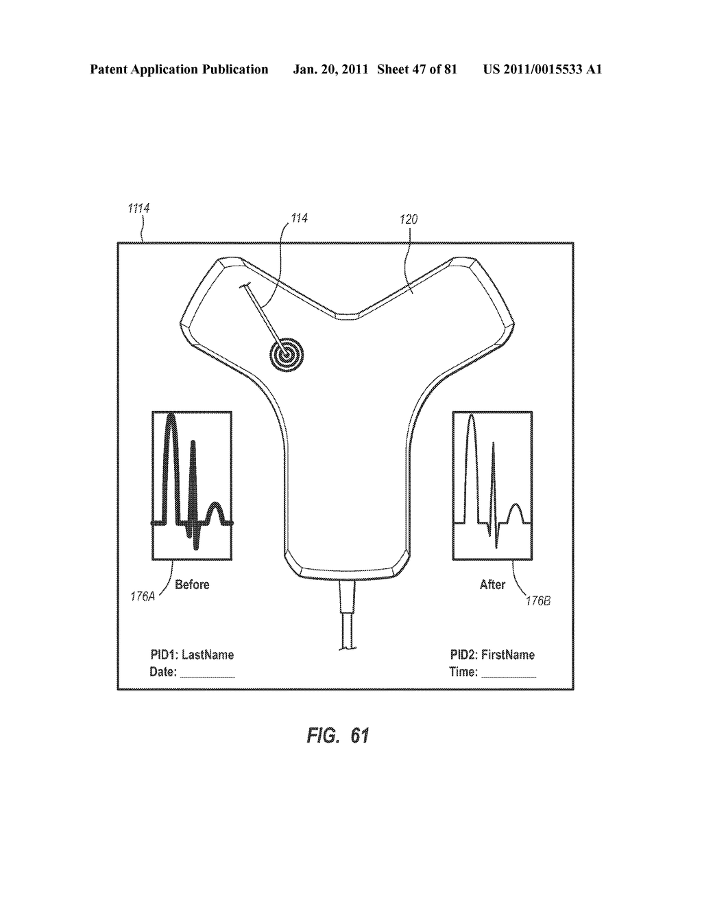 STYLETS FOR USE WITH APPARATUS FOR INTRAVASCULAR PLACEMENT OF A CATHETER - diagram, schematic, and image 48