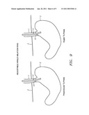 METHODS AND APPARATUS FOR TREATMENT OF OBESITY diagram and image