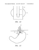 METHODS AND APPARATUS FOR TREATMENT OF OBESITY diagram and image