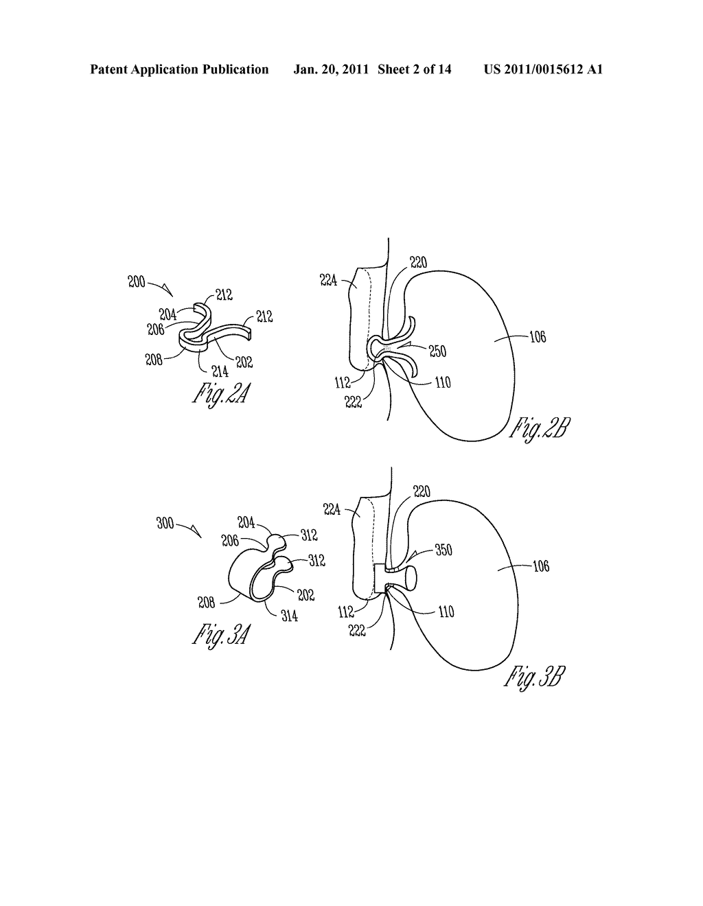 IMPLANTABLE DEVICES FOR TREATMENT OF SINUSITIS - diagram, schematic, and image 03