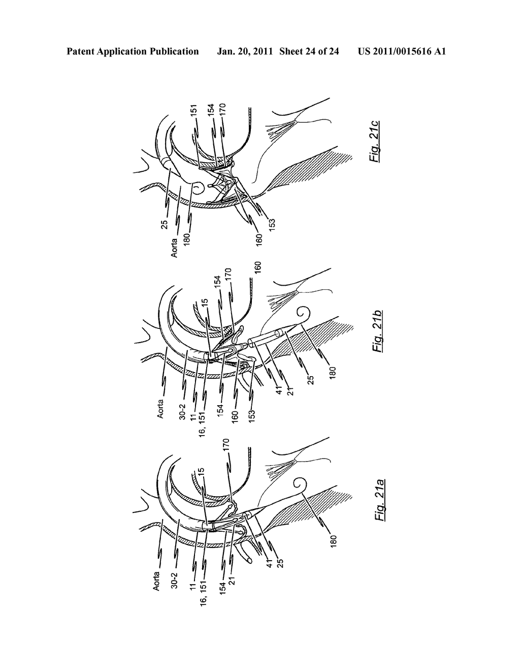 HANDLE FOR MANIPULATING A CATHETER TIP, CATHETER SYSTEM AND MEDICAL INSERTION SYSTEM FOR INSERTING A SELF-EXPANDABLE HEART VALVE STENT - diagram, schematic, and image 25