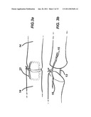 Device for assisting in flexor tendon repair and rehabilitation diagram and image