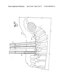 Spinal fixation tool set and method diagram and image