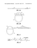 REMOTE PACE DETECTION IN AN IMPLANTABLE MEDICAL DEVICE diagram and image