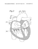 DEVICE AND METHOD FOR RESHAPING MITRAL VALVE ANNULUS diagram and image