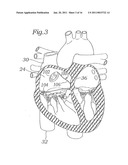 DEVICE AND METHOD FOR RESHAPING MITRAL VALVE ANNULUS diagram and image