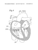 DEVICE AND METHOD FOR RESHAPING MITRAL VALVE ANNULUS diagram and image