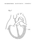 DEVICE AND METHOD FOR RESHAPING MITRAL VALVE ANNULUS diagram and image