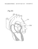 DEVICE AND METHOD FOR RESHAPING MITRAL VALVE ANNULUS diagram and image