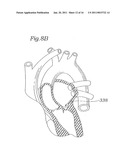 DEVICE AND METHOD FOR RESHAPING MITRAL VALVE ANNULUS diagram and image