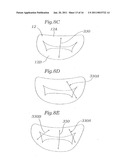 DEVICE AND METHOD FOR RESHAPING MITRAL VALVE ANNULUS diagram and image