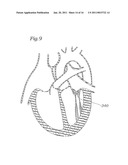 DEVICE AND METHOD FOR RESHAPING MITRAL VALVE ANNULUS diagram and image