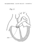 DEVICE AND METHOD FOR RESHAPING MITRAL VALVE ANNULUS diagram and image