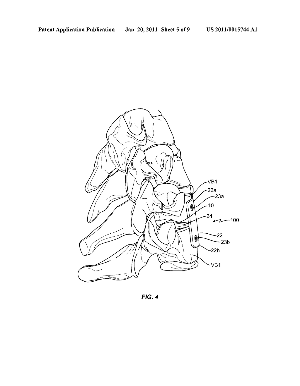 PROSTHETIC SPINAL DISC SYSTEM - diagram, schematic, and image 06