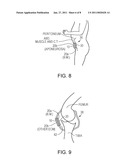 Variable Density Tissue Graft Composition and Methods of Making and Using the Same diagram and image