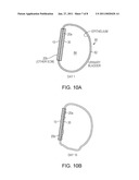 Variable Density Tissue Graft Composition and Methods of Making and Using the Same diagram and image