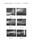 Materials and methods for wound treament diagram and image