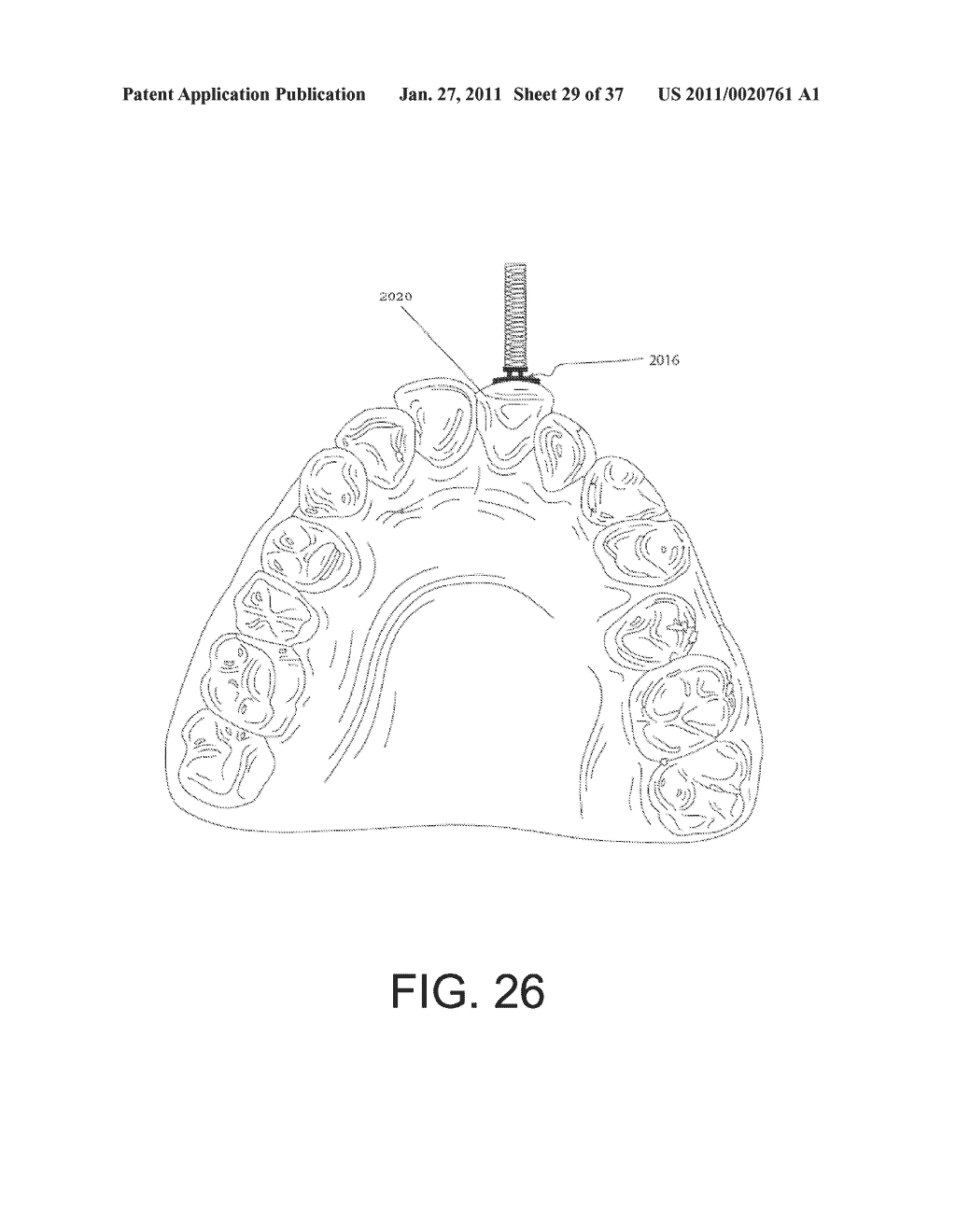 Orthodontic Repositioning Applicance - diagram, schematic, and image 30