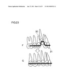 ORTHODONTIC BRACKET diagram and image