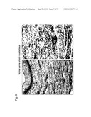 DETECTION OF UTERINE LEIOMYOSARCOMA USING LMP2 diagram and image