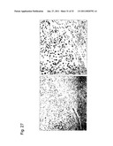 DETECTION OF UTERINE LEIOMYOSARCOMA USING LMP2 diagram and image