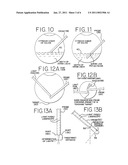 Methods and Apparatus for Intraocular Brachytherapy diagram and image