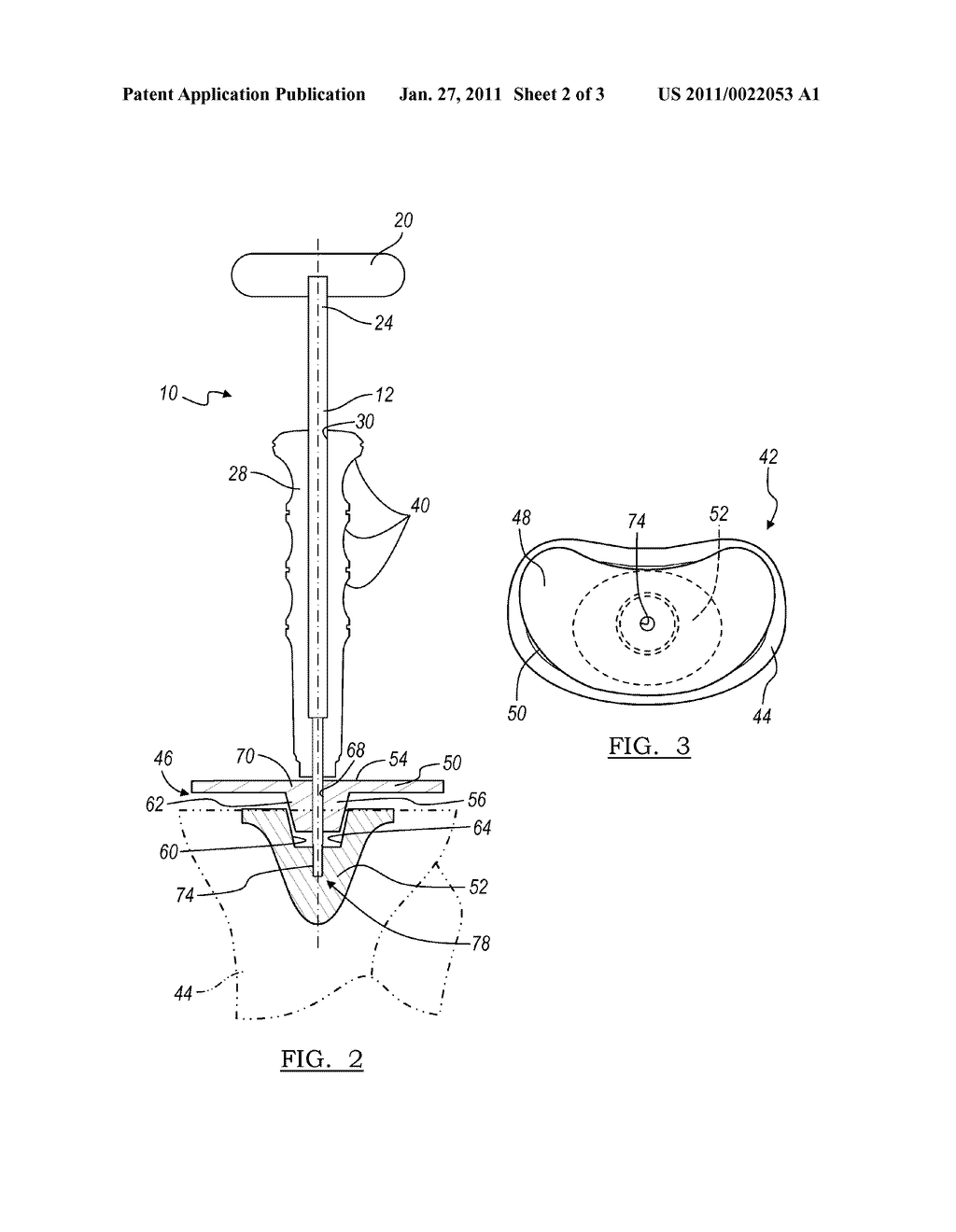 Method and Apparatus for Assembling Implants - diagram, schematic, and image 03