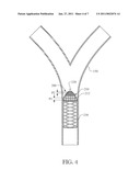 PERMANENT ARTERIAL EMBOLI DISSOLUTION FILTER TO PREVENT EMBOLIC OCCLUSION OF A BLOOD VESSEL diagram and image