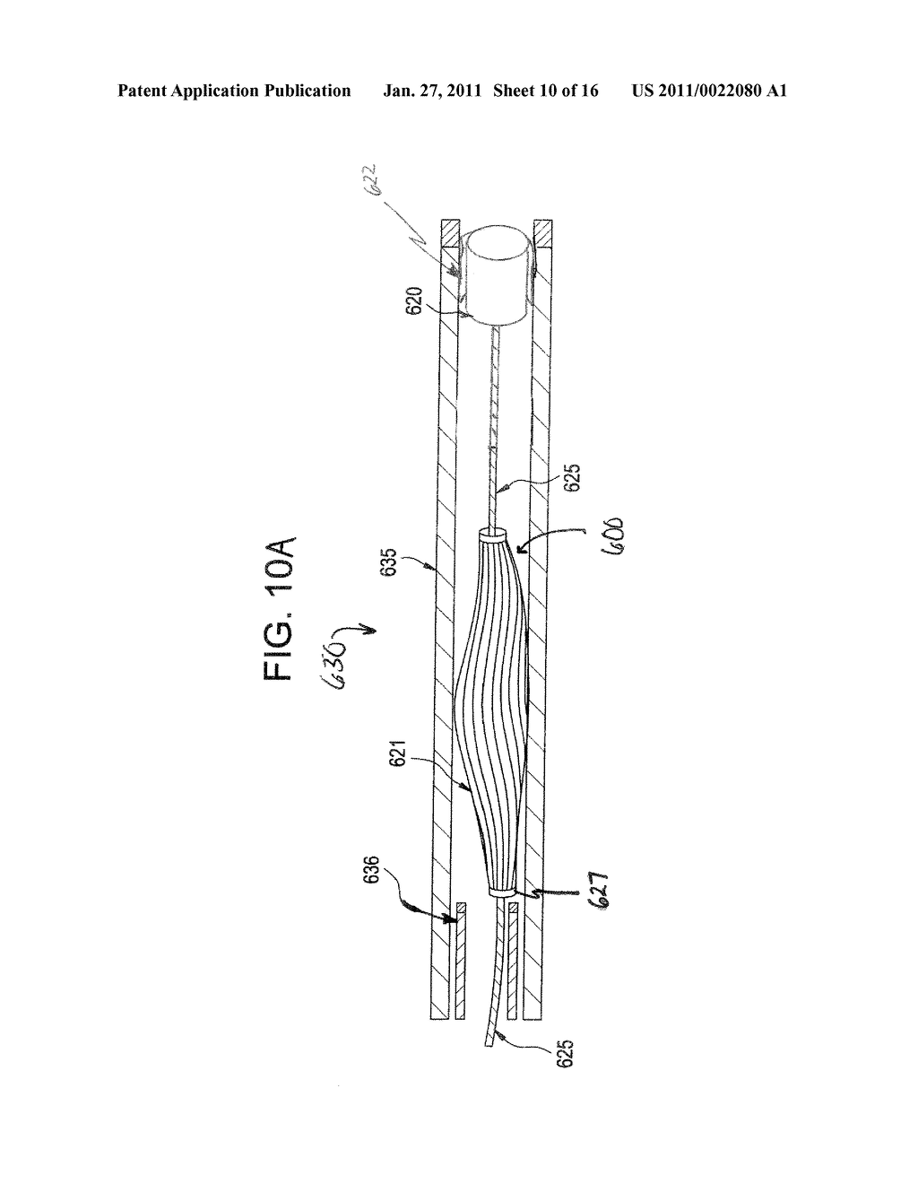 SINGLE DISC INTRALUMINAL FIXATION PATENT FORAMEN OVALE CLOSURE DEVICE - diagram, schematic, and image 11