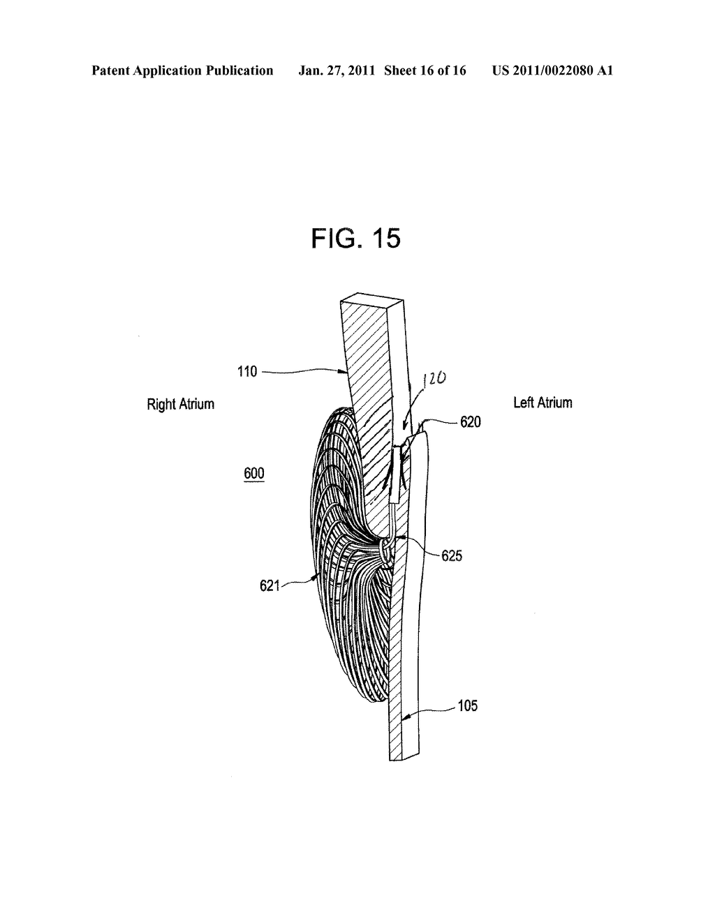 SINGLE DISC INTRALUMINAL FIXATION PATENT FORAMEN OVALE CLOSURE DEVICE - diagram, schematic, and image 17