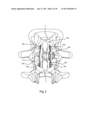 SPINOUS PROCESS FUSION IMPLANTS diagram and image