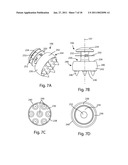 SPINOUS PROCESS FUSION IMPLANTS diagram and image