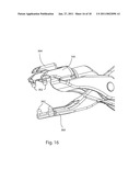 SPINOUS PROCESS FUSION IMPLANTS diagram and image