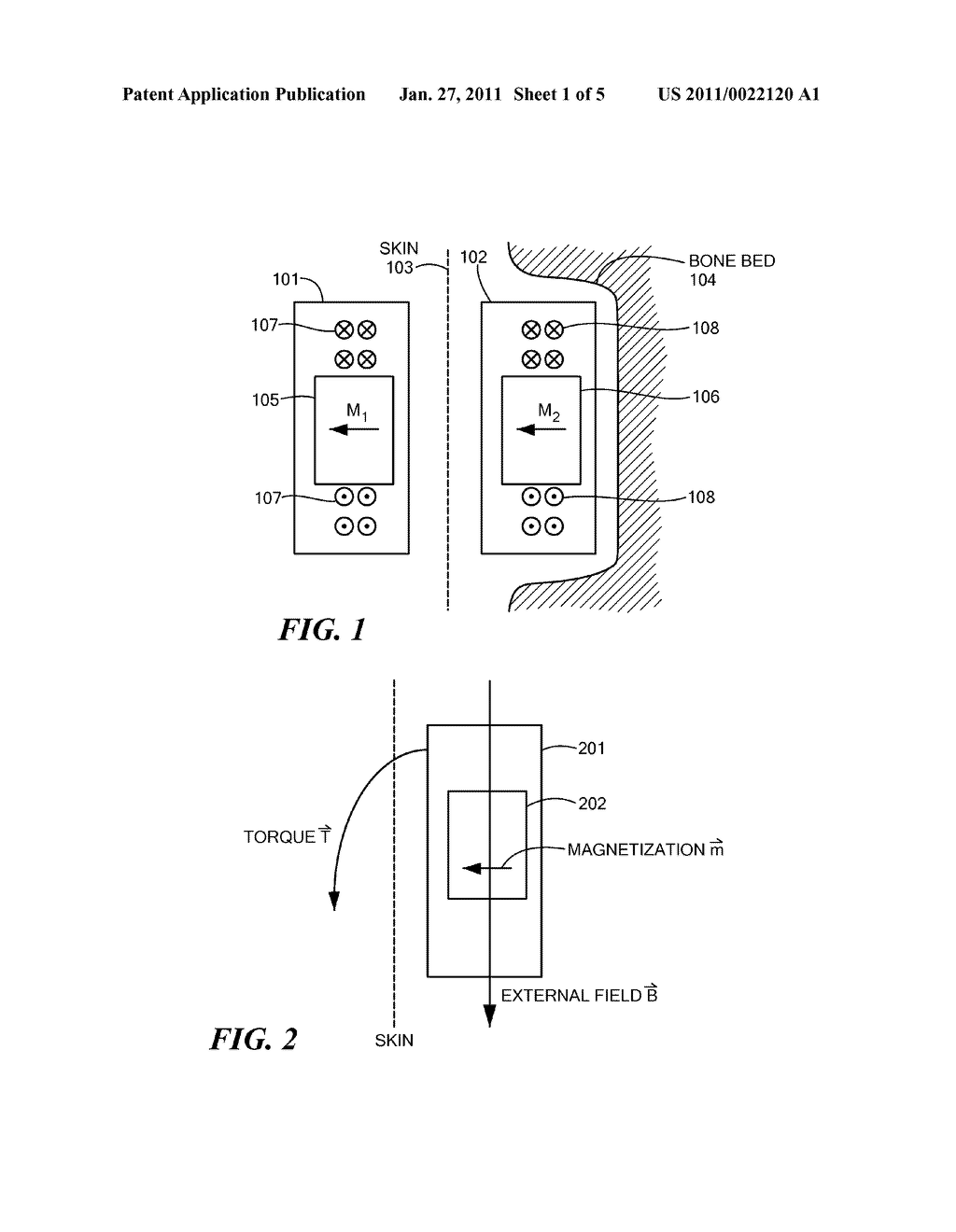 Magnetic Attachment Arrangement for Implantable Device - diagram, schematic, and image 02