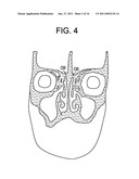 Intranasal Red Light Probe For Treating Alzheimer s Disease diagram and image