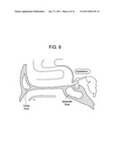 Intranasal Red Light Probe For Treating Alzheimer s Disease diagram and image