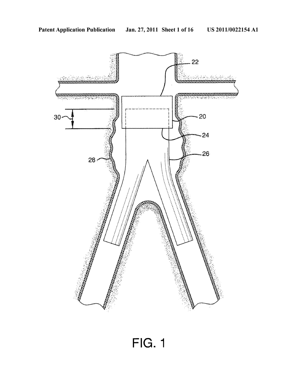 ENDOLUMINAL PROSTHETIC CONDUIT SYSTEMS AND METHOD OF COUPLING - diagram, schematic, and image 02