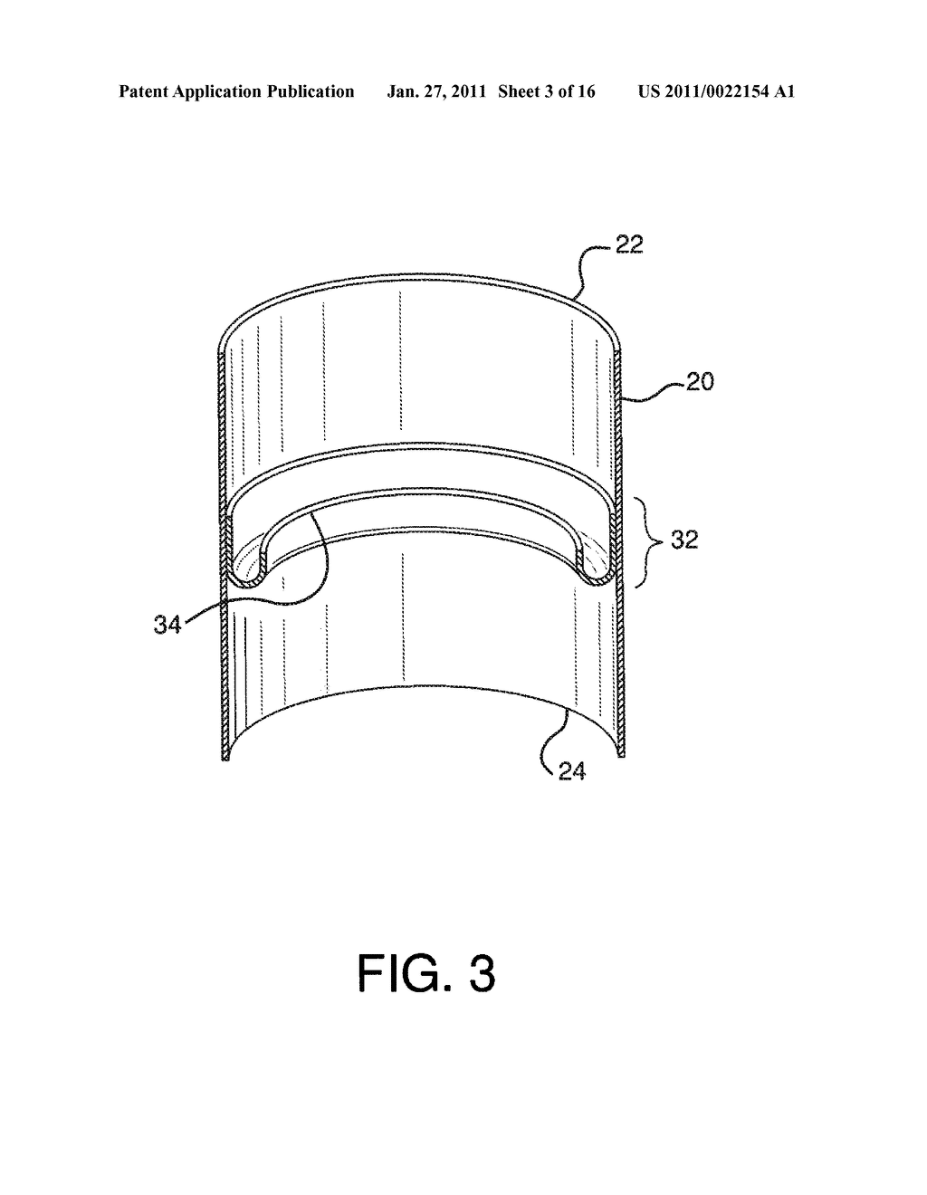 ENDOLUMINAL PROSTHETIC CONDUIT SYSTEMS AND METHOD OF COUPLING - diagram, schematic, and image 04