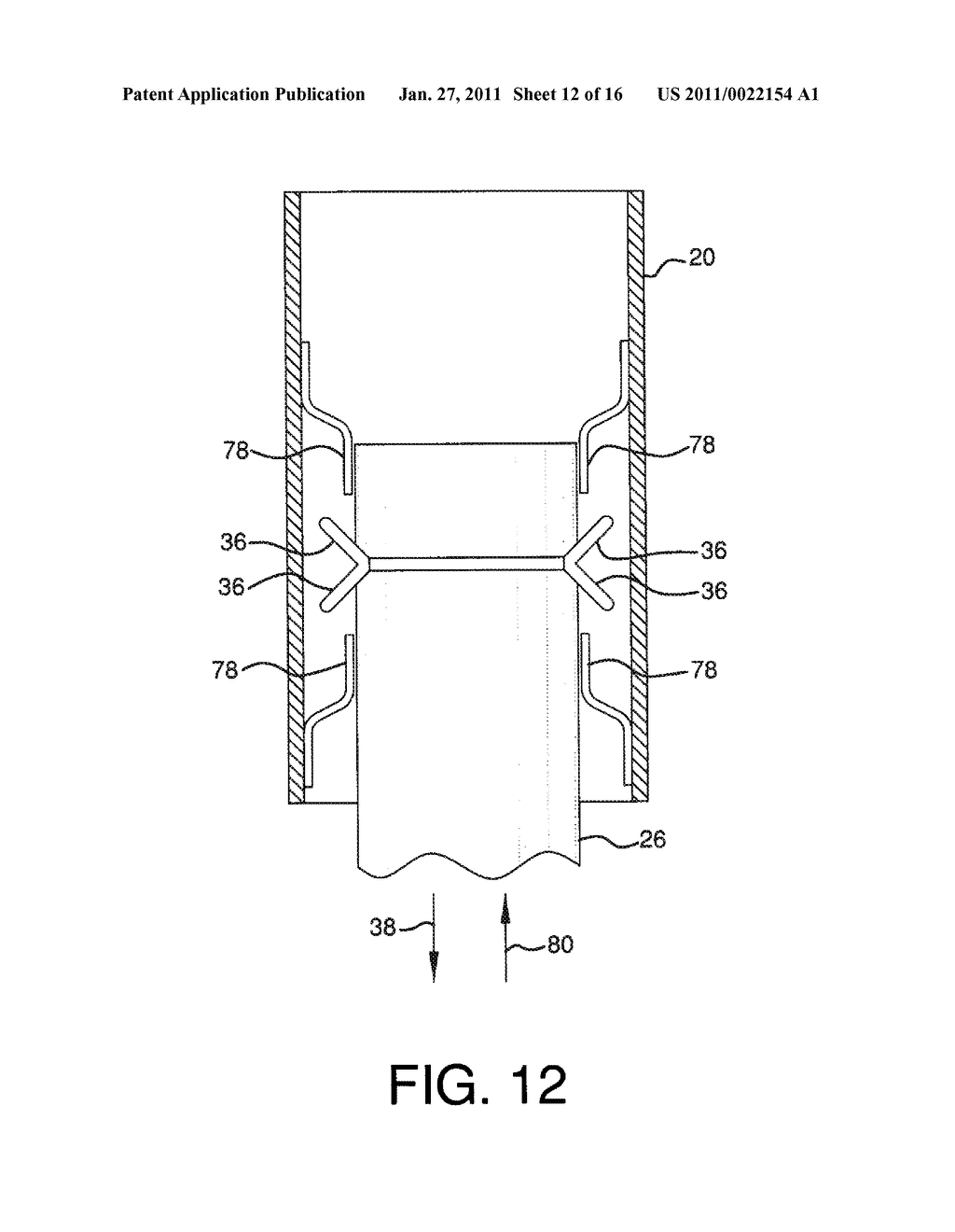 ENDOLUMINAL PROSTHETIC CONDUIT SYSTEMS AND METHOD OF COUPLING - diagram, schematic, and image 13