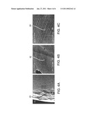 ENDOPROSTHESES diagram and image