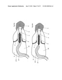 MEDICAL DEVICE FOR USE IN TREATMENT OF A VALVE diagram and image