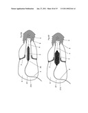 MEDICAL DEVICE FOR USE IN TREATMENT OF A VALVE diagram and image