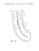 METHODS FOR REMOVING DEBRIS FROM MEDICAL TUBES diagram and image