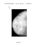 SYSTEMS, COMPUTER-READABLE MEDIA, AND METHODS FOR CLASSIFYING AND DISPLAYING BREAST DENSITY diagram and image