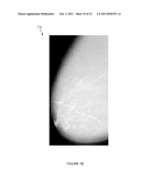 SYSTEMS, COMPUTER-READABLE MEDIA, AND METHODS FOR CLASSIFYING AND DISPLAYING BREAST DENSITY diagram and image