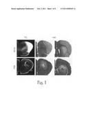 Endothelial monocyte activation polypeptide II, a biomarker for use in diagnosis and treatment of brain injury diagram and image