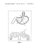 Peroral transgastric endoscopic techniques diagram and image