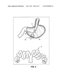 Peroral transgastric endoscopic techniques diagram and image