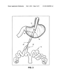 Peroral transgastric endoscopic techniques diagram and image