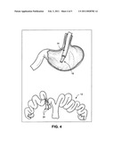 Peroral transgastric endoscopic techniques diagram and image